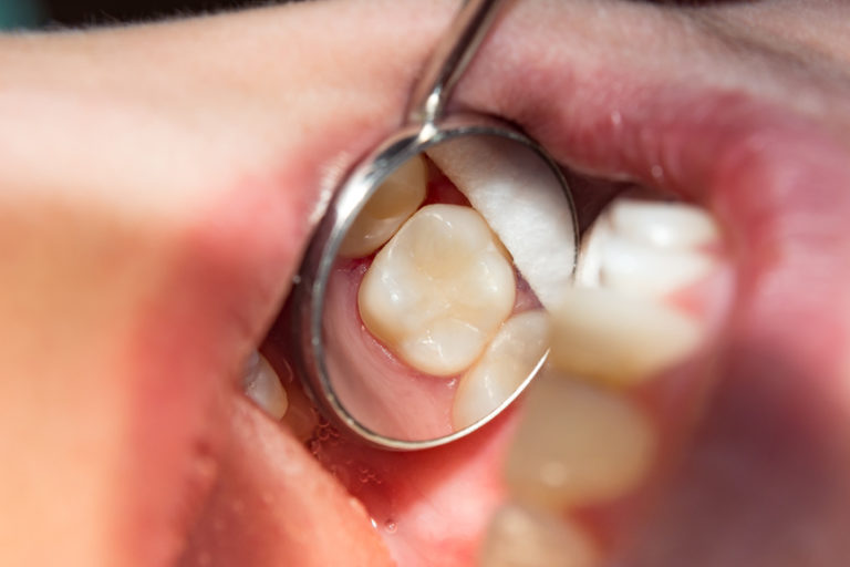 How to Make Your Tooth Fillings Last Park Hill East Dental Care